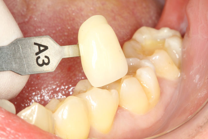 奥歯のセラミックインレーの色について