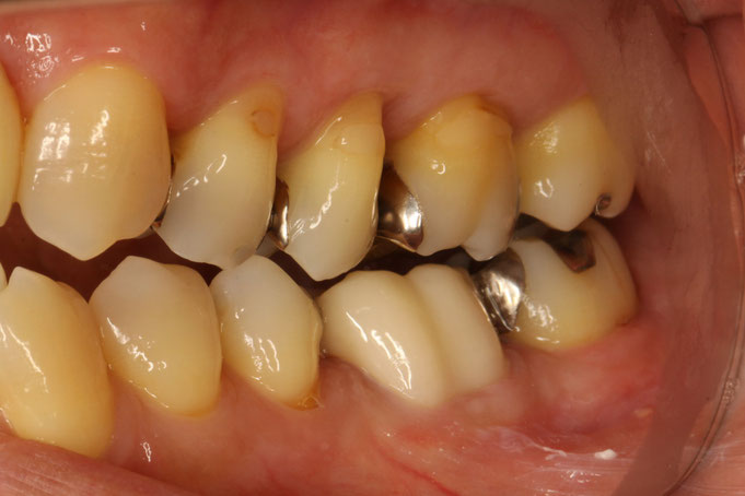 奥歯の白いオールセラミックの色について