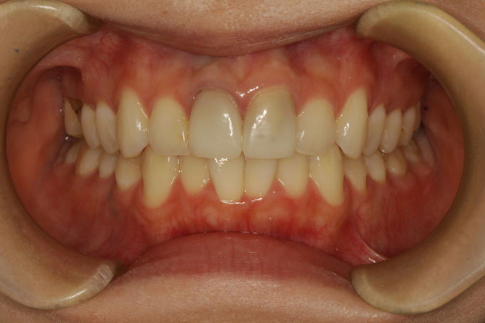 歯の大きさを整える審美歯科治療の仮歯の秘密