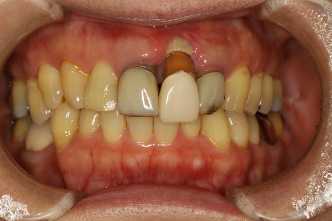 歯茎が下がってしまった時の審美歯科治療は新しい審美歯科治療が必要です。