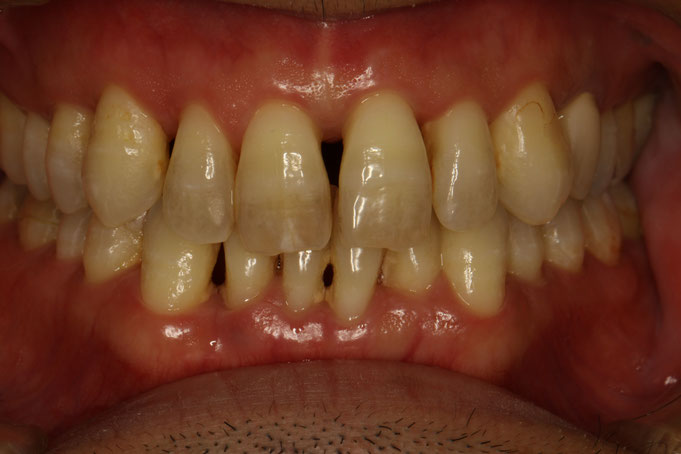 歯周病の方のための審美歯科治療。
