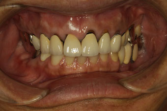 審美歯科ブログ：オールセラミック治療をしても歯茎の黒ずみが残ることも。本当に問題ない？