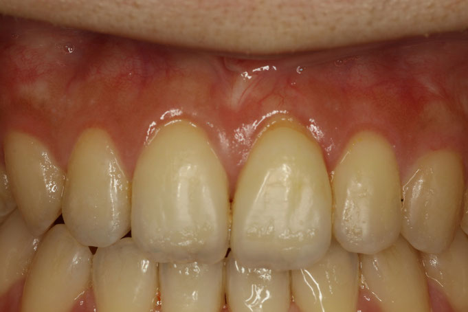 あなたの歯茎の見た目が審美的に見える方法について