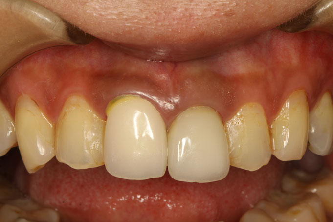歯の大きさを小さくする審美歯科治療とは