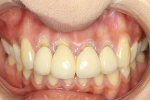 差し歯の歯茎の退縮