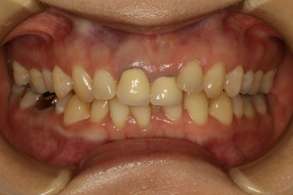 審美歯科治療前に歯並びを整えた方が良い場合とは