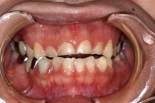 知覚過敏があるけど、歯をきれいにしたい方のための審美歯科治療法