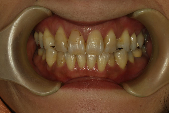 変色した歯でお困りの方。審美歯科をする前に歯の長さが長くならないようにご注意ください。