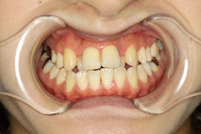知らないと損する審美歯科。お勧めしない歯並び治療とは。