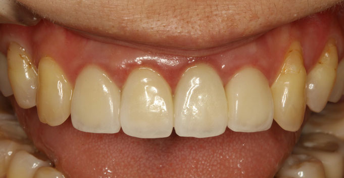 あなたの差し歯の歯茎は大丈夫？差し歯の歯茎の腫れは歯茎が下がる原因です。