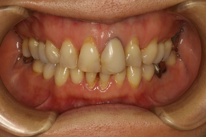 長くなってしまった差し歯を新しくするなら新しい審美歯科治療法がオススメです。