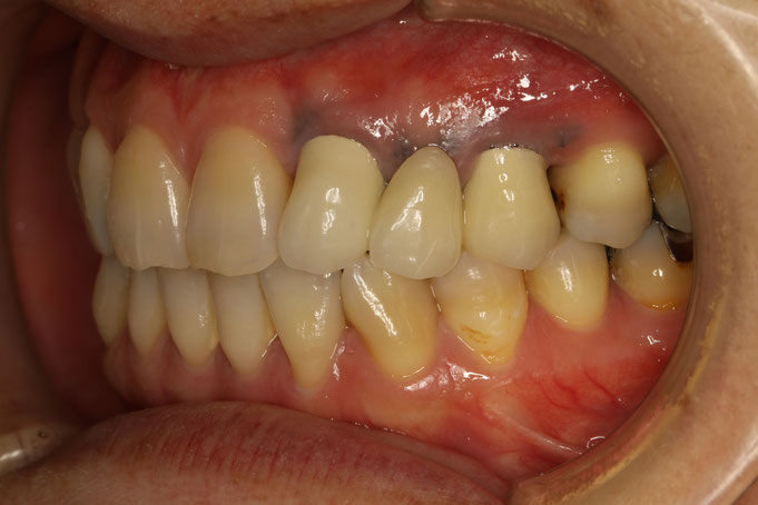 歯茎の黒ずみのある場合の審美歯科治療