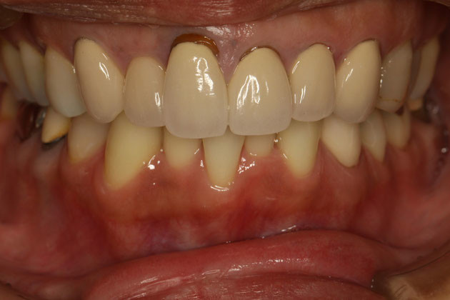 もうご存知ですね。前歯の審美歯科治療には歯茎の位置を整える歯茎の再生・整形が必要です。