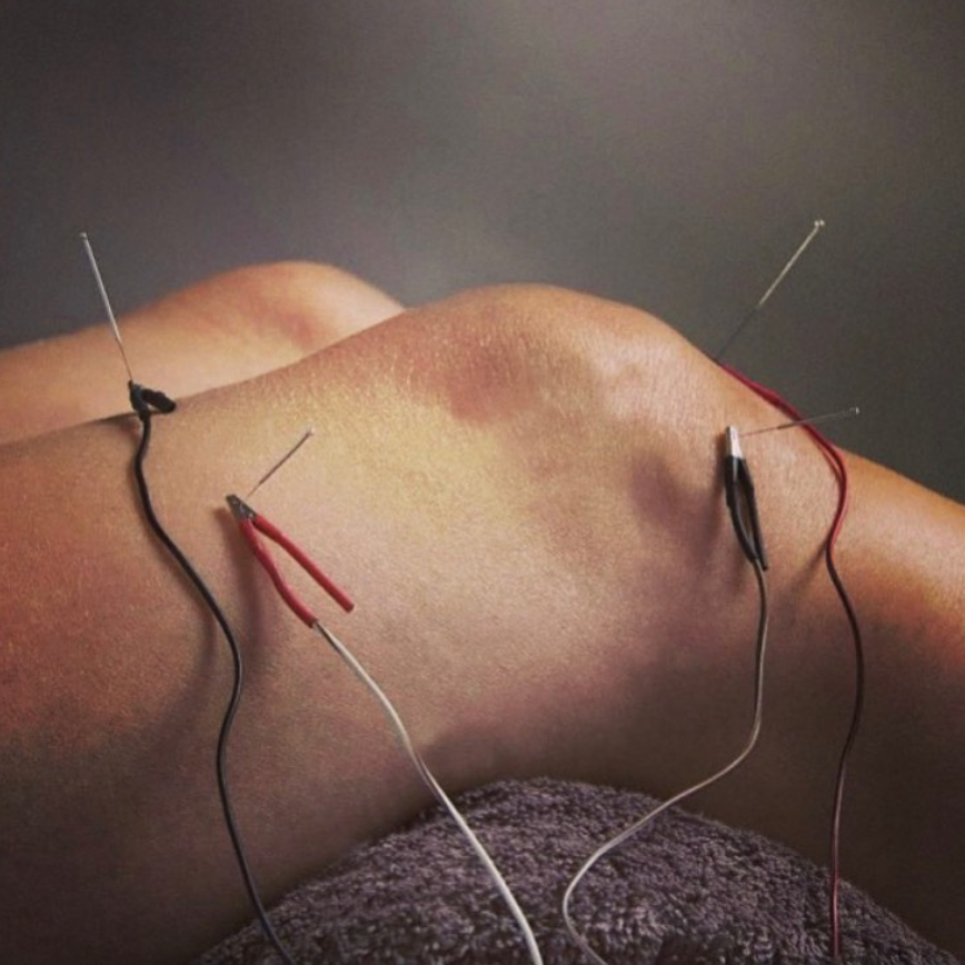 Acupuntura y Rendimiento Deportivo: La Clave para Superar tus Limites y Prevenir Lesiones