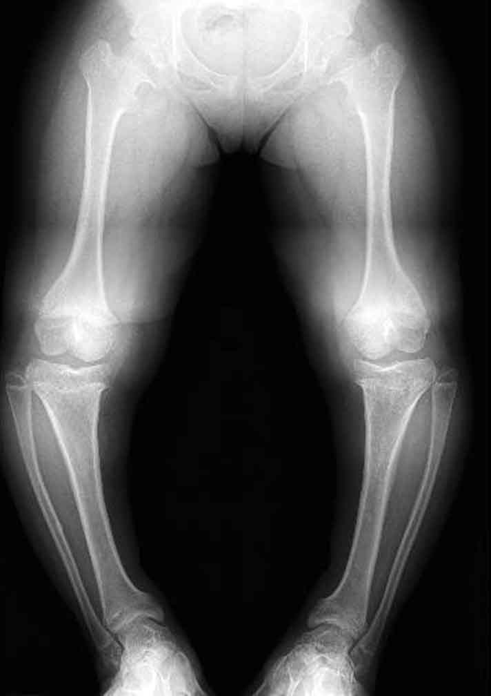 Lower limbs of an adult with achondroplasia.