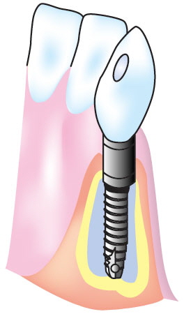 ご自身の歯の代わりとなる「第３の歯」インプラント