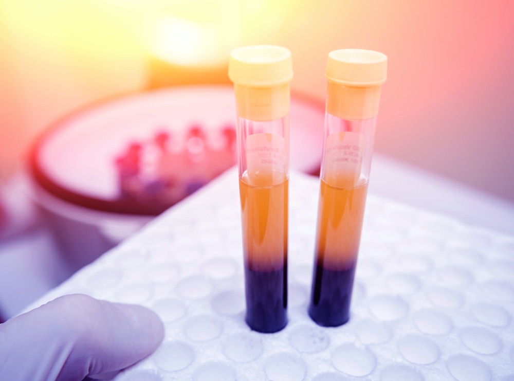 EIGENBLUTTHERAPIE (PRP) bei Analfissuren und Steissbeinfisteln