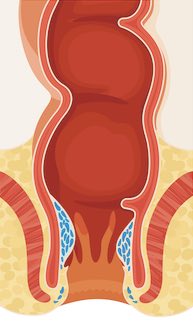 Hämorrhoiden - Wie gehe ich damit um?