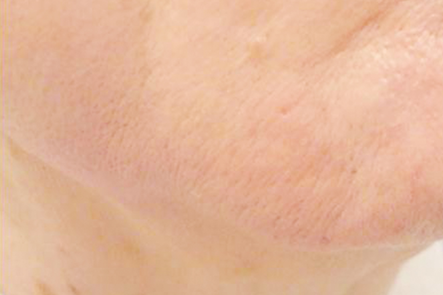 Gesichtshaare (nach Behandlung)