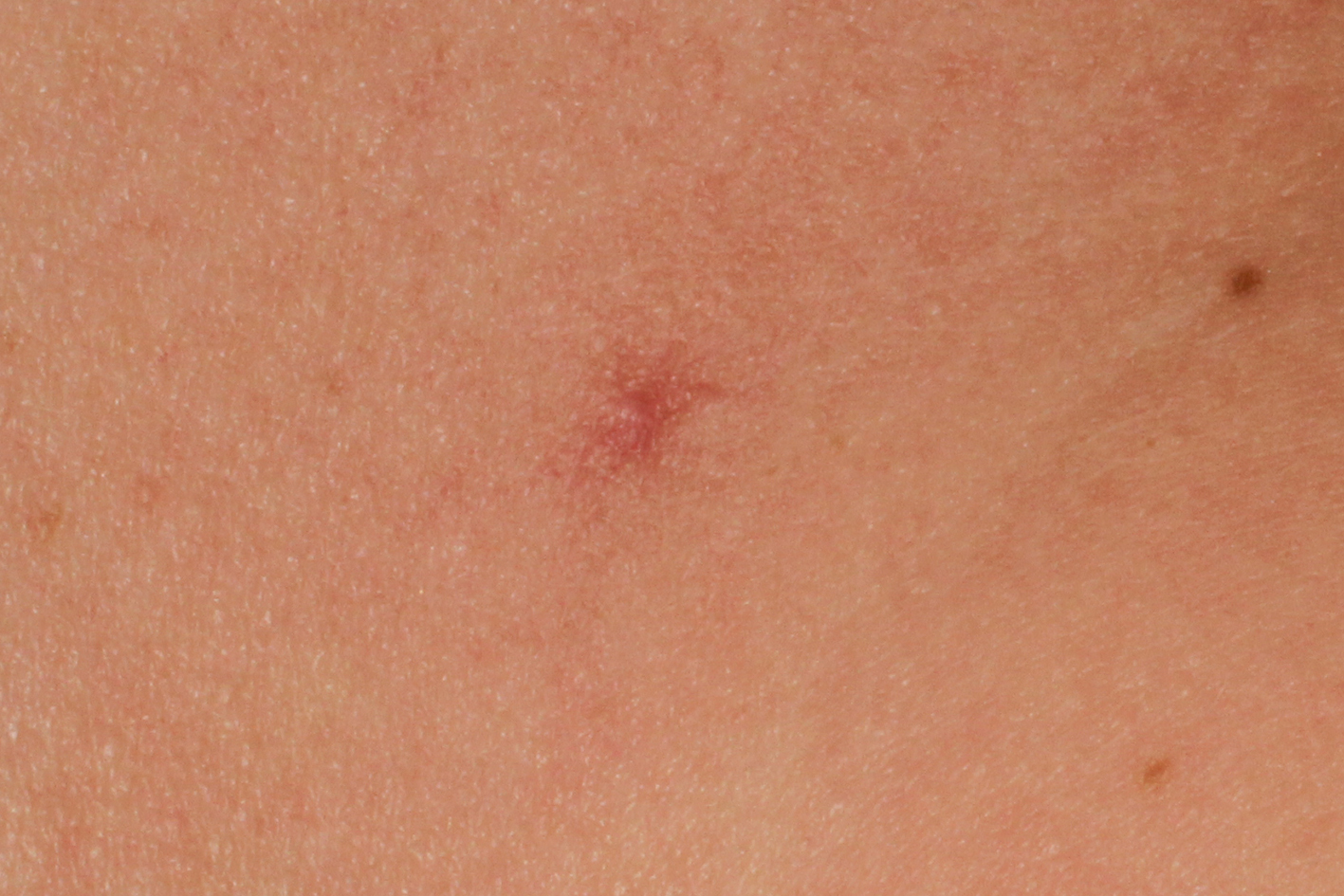 Spinnenmale (vor Behandlung)
