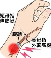 ド・ケルバン病（腱鞘炎）の解剖図。短母指伸筋腱と長母指外転筋腱が腱鞘内で炎症を起こしている部位を図解。親指付け根の痛みの原因を示した医療イラスト