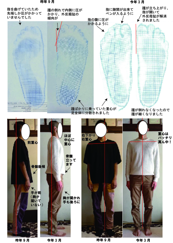 高校生　足の変化がスゴカッタ！