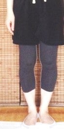 友人の2年越しの施術変化（O脚矯正と姿勢）