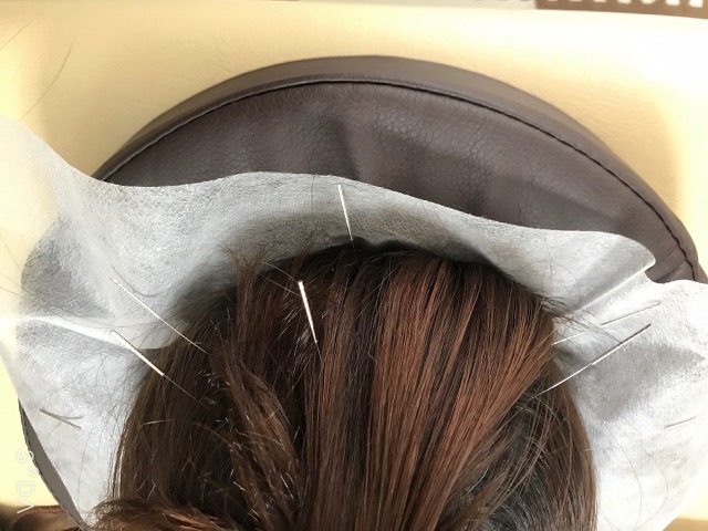 疲労改善に効果的な頭皮鍼 愛知県小牧市にある 自律神経の乱れに対する治療のスペシャリスト ケーズはりきゅう治療院