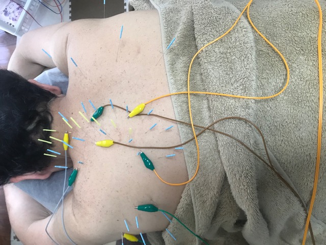 背中のビリビリとした感覚 愛知県小牧市にある 自律神経の乱れに対する治療のスペシャリスト ケーズはりきゅう治療院