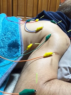 小牧 肩こり 肩痛 腰痛 鍼灸