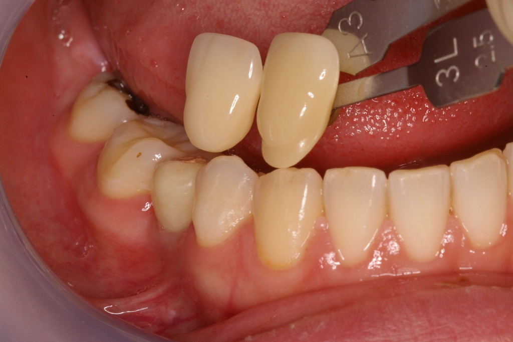 歯科技工ジルコニアクラウンダブルスキャンで製作