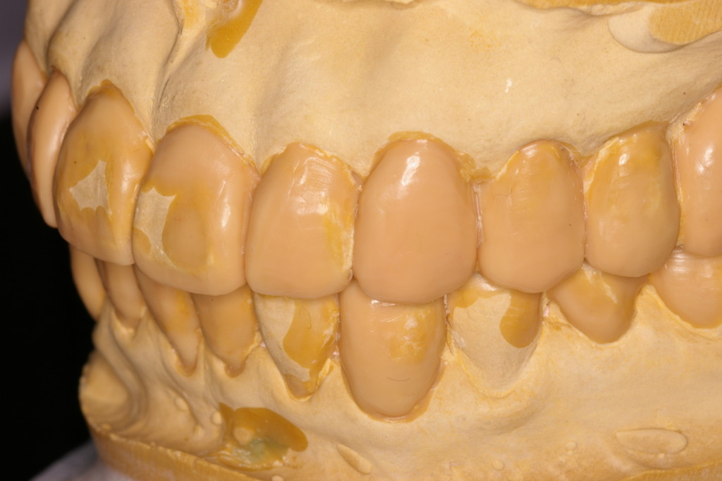 各歯牙の歯軸の傾きは？