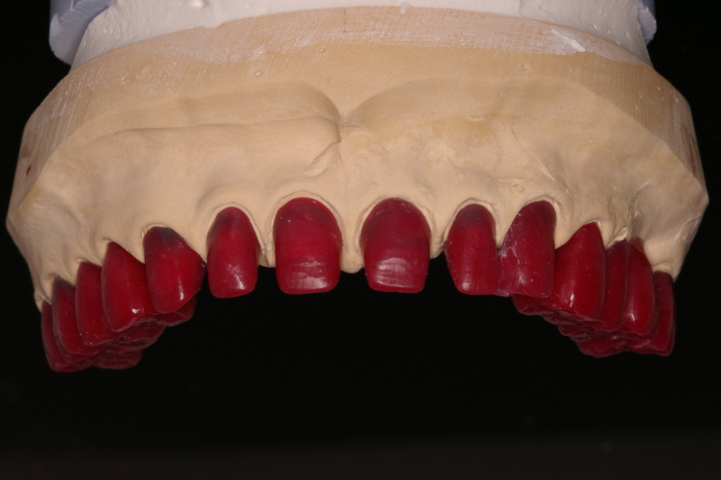 歯科技工　ジルコニアクラウン　フルマウス　ダブルスキャンで製作 歯科技工 ジルコニアクラウン フルマウス ダブルスキャンで製作