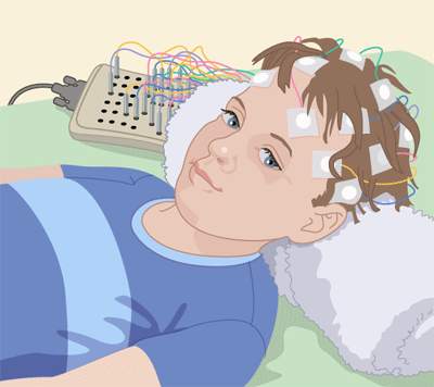 EEG Electroencefalograma.