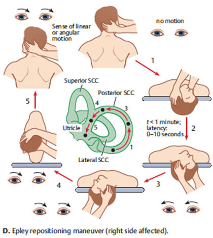 La maniobra de Epley. VPPB.