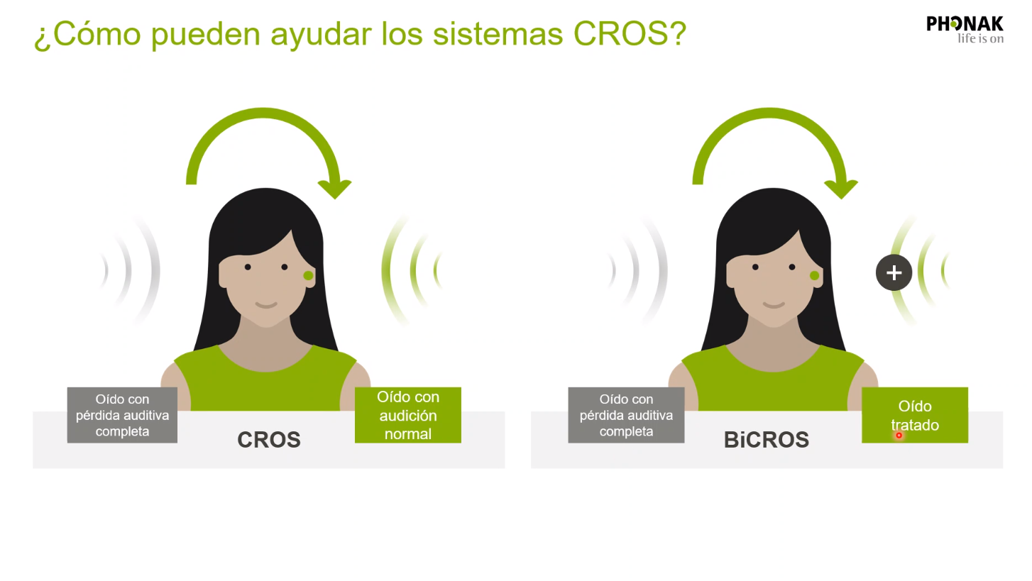 Phonak Cros: Oído derecho con pérdida auditiva total, oído izquierdo con audición (izq), o con pérdida corregida con audifono (dcha).