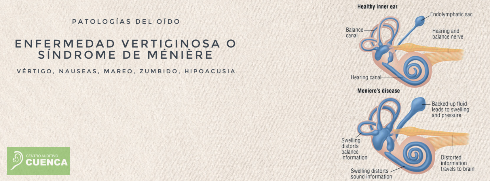 Méniére, vértigos, náuseas, acúfenos, hipoacusia....