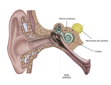 Neurinoma del acústico. Tumor benigno del oído.