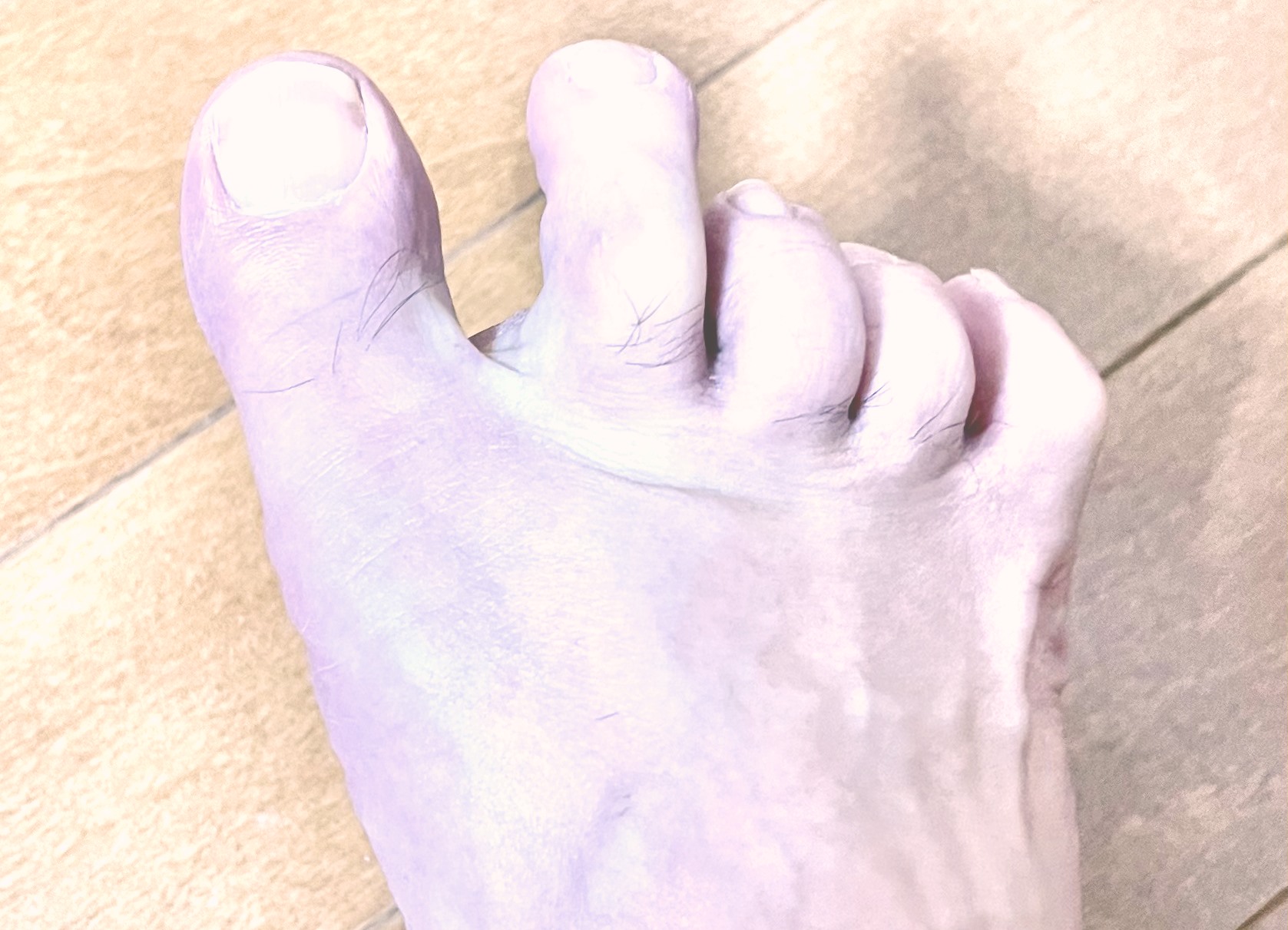 足の爪の処置