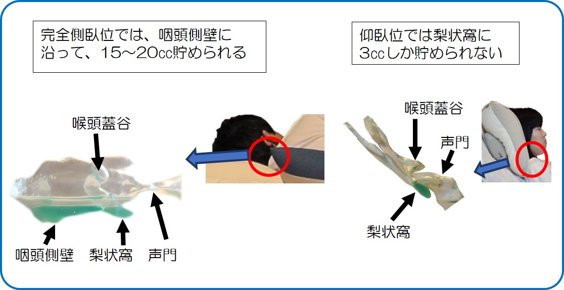 完全側臥位支援クッション(誤嚥予防介護クッション) 誤嚥 誤嚥性肺炎 安全に口から食べられる完全側臥位法の紹介 誤嚥しにくい頭頸部を簡単に調整 摂食嚥下障害者・高齢者の嚥下枕 ビーズ枕で頭 完全側臥位支援クッション(誤嚥予防介護クッション) 誤嚥 誤嚥性肺炎 安全に口から食べられる完全側臥位法の紹介 誤嚥しにくい頭頸部を簡単に調整 摂食嚥下障害者・高齢者の嚥下枕 ビーズ枕で頭