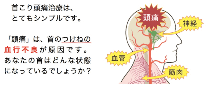 頭痛は首の付け根の血行不良が原因です。あなたの首はどのような状態になっているのでしょうか？