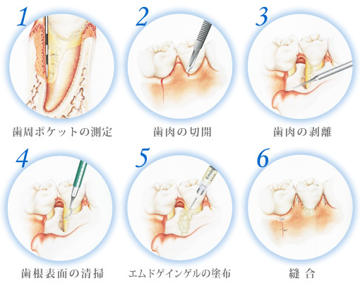 歯周病治療 市原市の歯科 三橋歯科医院