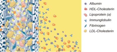 DFPP Lipidfiltration 血液净化 德国欧亚商旅