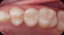 Restaurations Esthetiques Des Dents Posterieures Approche Moderne Aonews Aonews Le Magazine Dentaire Qui Nous Rassemble