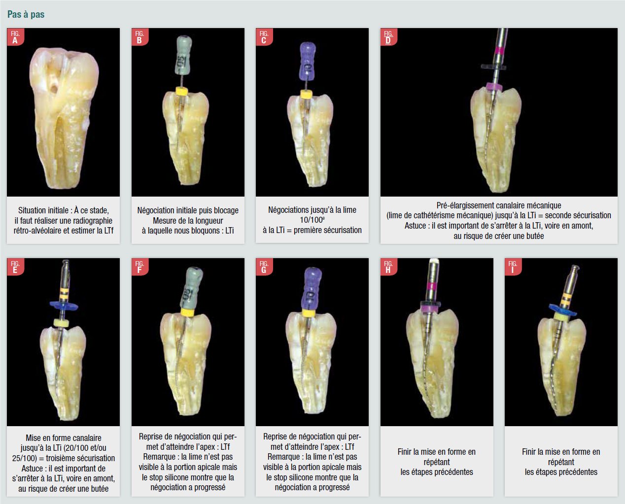 AO 52 securisation canalaire S Yee sept 2022 AOnews le magazine dentaire qui nous rassemble