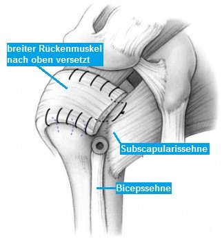 Rotatorenmanschettenruptur Risse In Der Sehnenkappe Uber Dem Oberarmkopf Ortho Clinics Webseite