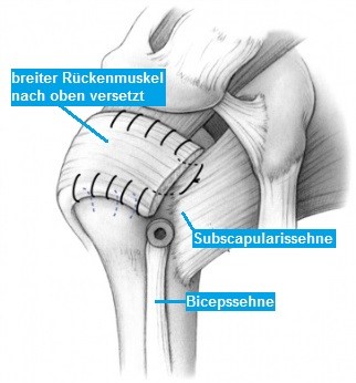 Supraspinatussehne teilruptur der Partialläsion der