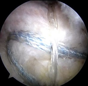 Arthroskopisches Bild nach Naht der Sehne in der Doppelreihentechnik („double row“)
