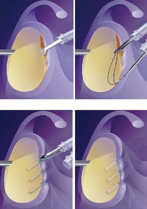 Schematisches Bild einer arthrosko-pischen Refixation der Lippe, der Kapsel und der Bänder am Pfannenrand.