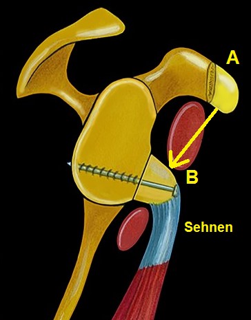 Die Spitze des Rabenschnabelfortsatzes (A) (ca 2-3cm Knochen) wird zusammen mit den Sehnen abgelöst und in die Position B versetzt und dort am Pfannenrand mit 1 oder 2 Schrauben fixiert.